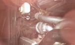 Si je veux conserver cette solution, je devrais réaliser un manchon pour surélever la durite et l'éloigner du turbo et de la chapelle d'amortisseur .Je devrais aussi fabriquer un écran thermique à interposer entre le corps chaud et la durite en question.